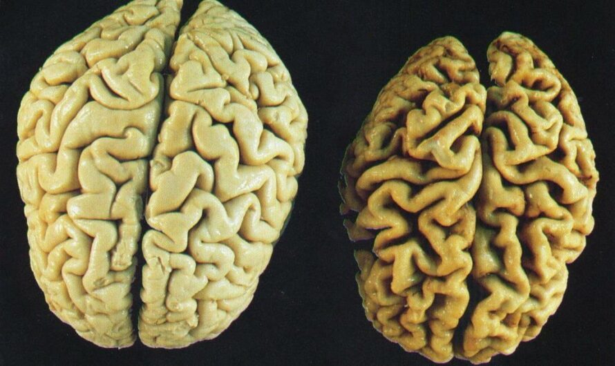 New Study Suggests Brain Fungal Infection Could Lead to Alzheimer’s Disease-like Changes