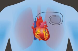 cardiac Pacemaker Market