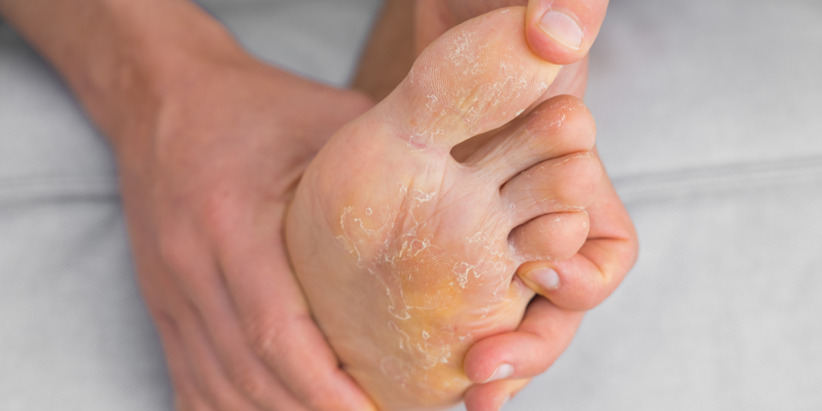 Fungal Skin Infections