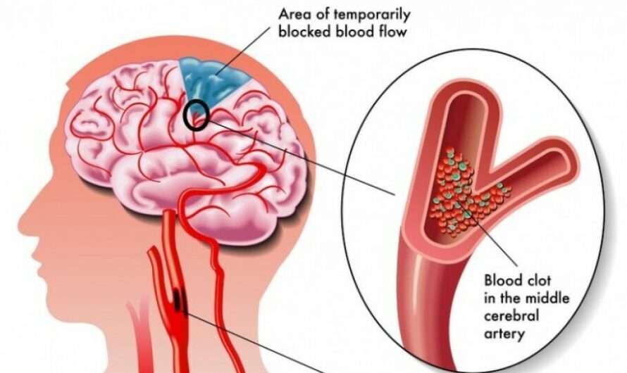 The Acute Ischemic Stroke (AIS) Market is poised to witness Robust Growth driven by Increasing Incidence of Stroke